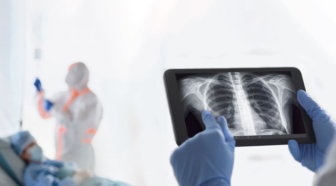 COVID-X finanzierà un progetto synbrAIn sulle immagini radiografiche