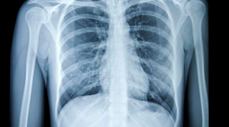 Read more about the article SenticLab Achieves a Milestone at NODE21 for Lung Cancer Detection