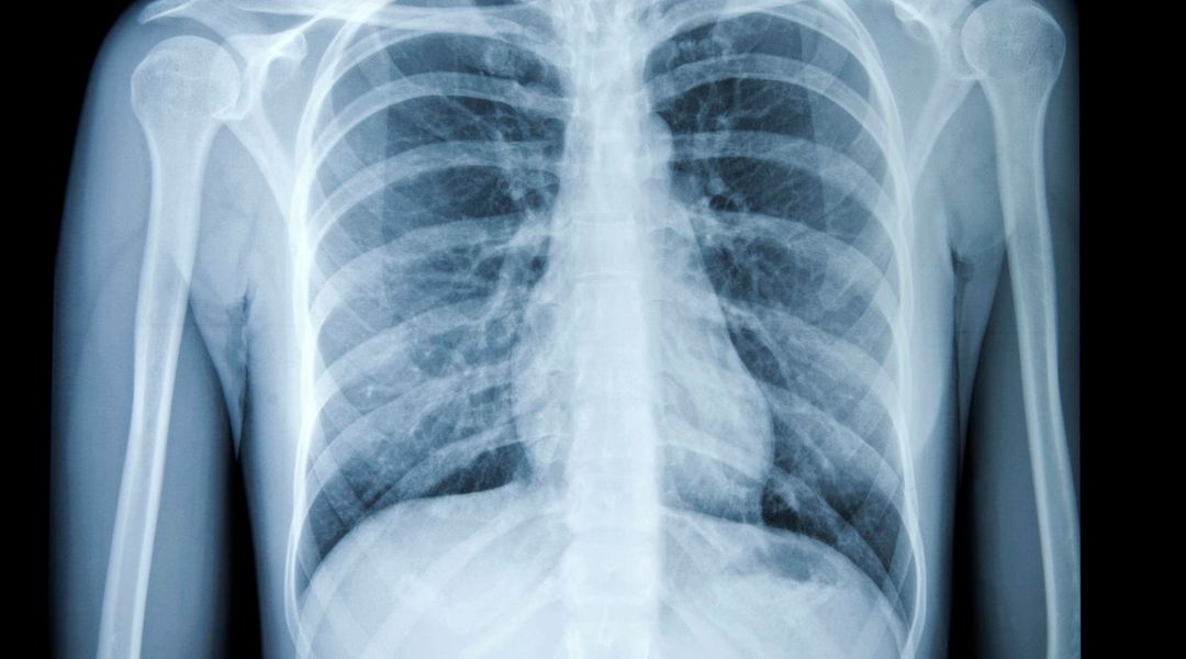 NODE21 riconoscimento a SenticLab per il cancro al polmone