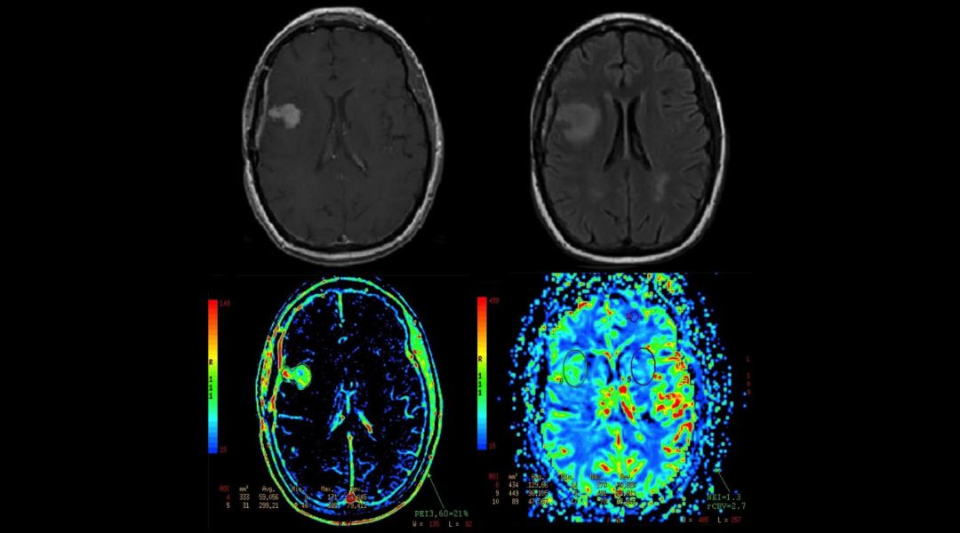 Radiomica MRI del cervello