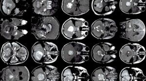 Scopri di più sull'articolo Assessment of the effect of intensity standardization on the reliability of T1-weighted MRI radiomic features: experiment on a virtual phantom