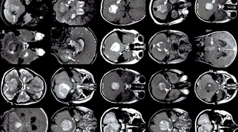 Scopri di più sull'articolo Assessment of the effect of intensity standardization on the reliability of T1-weighted MRI radiomic features: experiment on a virtual phantom