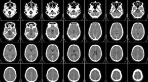 Scopri di più sull'articolo A multi-metric registration strategy for the alignment of longitudinal brain images in pediatric oncology