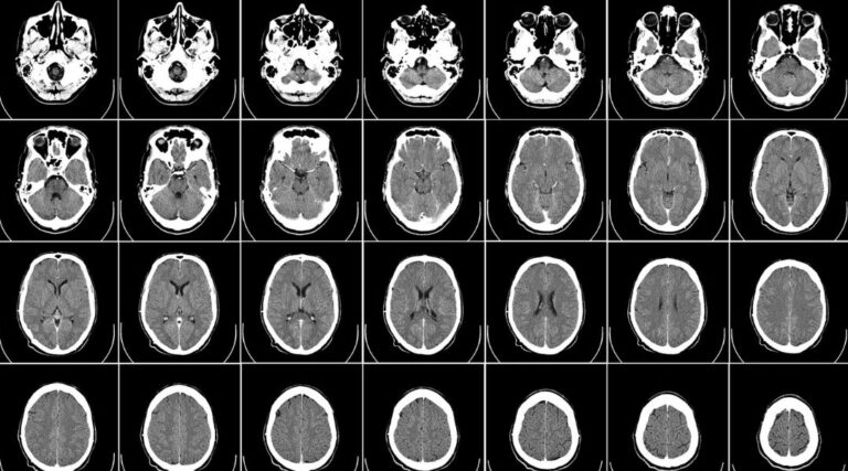 Scopri di più sull'articolo A multi-metric registration strategy for the alignment of longitudinal brain images in pediatric oncology