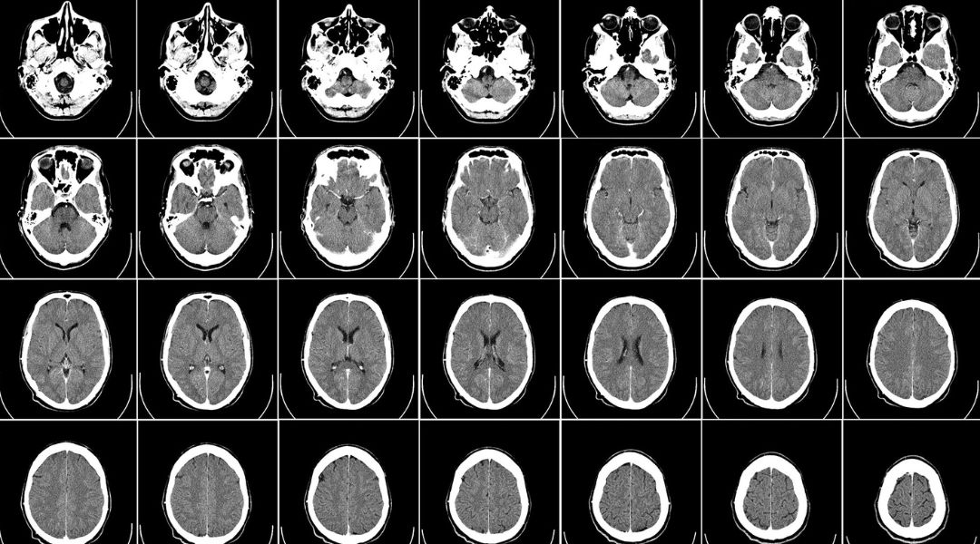 A multi-metric registration strategy for the alignment of longitudinal brain images in pediatric oncology