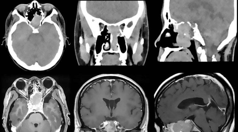 Scopri di più sull'articolo Relevance of apparent diffusion coefficient features for a radiomics-based prediction of response to induction chemotherapy in sinonasal cancer