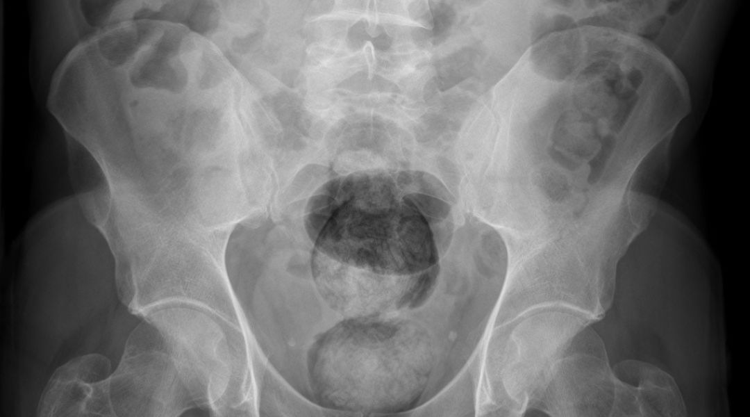 Cancro del retto