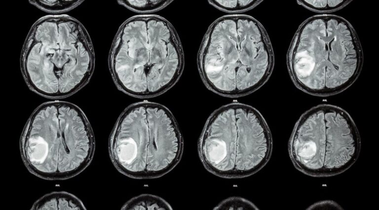 Scopri di più sull'articolo Methodology and technology for the development of a prognostic MRI-based radiomic model for the outcome of head and neck cancer patients