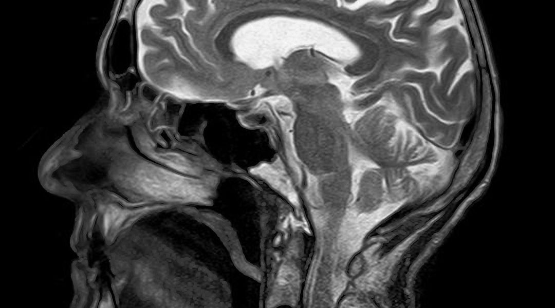 Carcinoma nasofaringeo non endemico