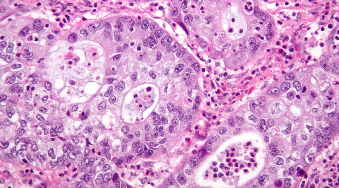 Carcinoma squamocellulare