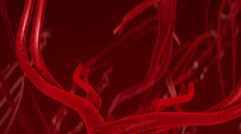 Scopri di più sull'articolo Fluid-dynamics and biological features of unstable plaques: different shear stress for different plaques