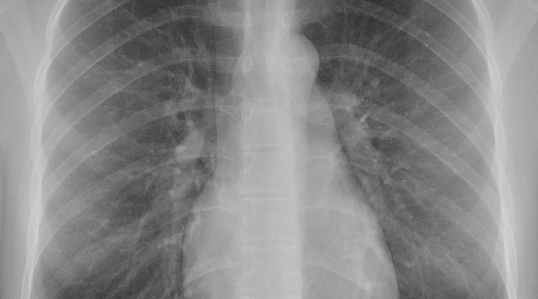 ImageClef 2020 Tuberculosis