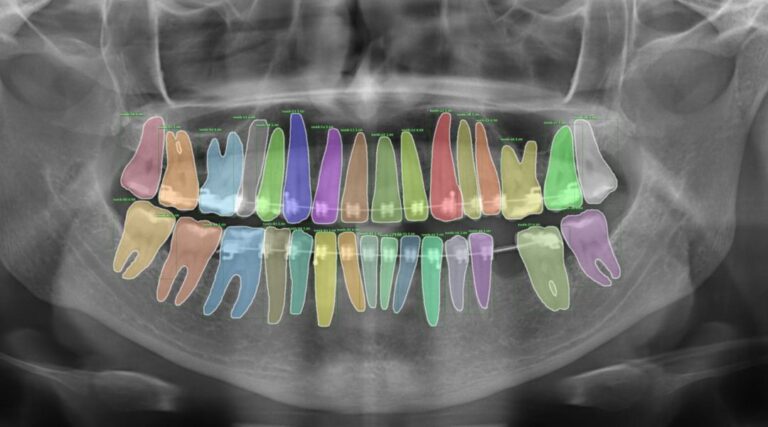 Scopri di più sull'articolo Teeth Segmentation in Panoramic Dental X-ray Using Mask Regional Convolutional Neural Network