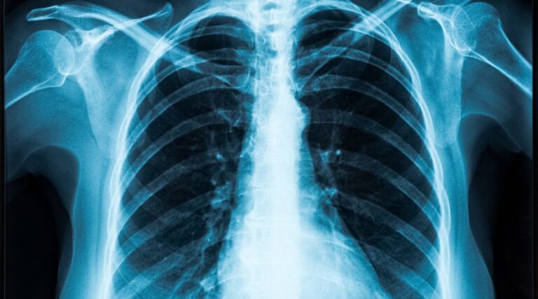 Scopri di più sull'articolo Artificial Intelligence Applied to Chest X-ray: A Reliable Tool to Assess the Differential Diagnosis of Lung Pneumonia in the Emergency Department