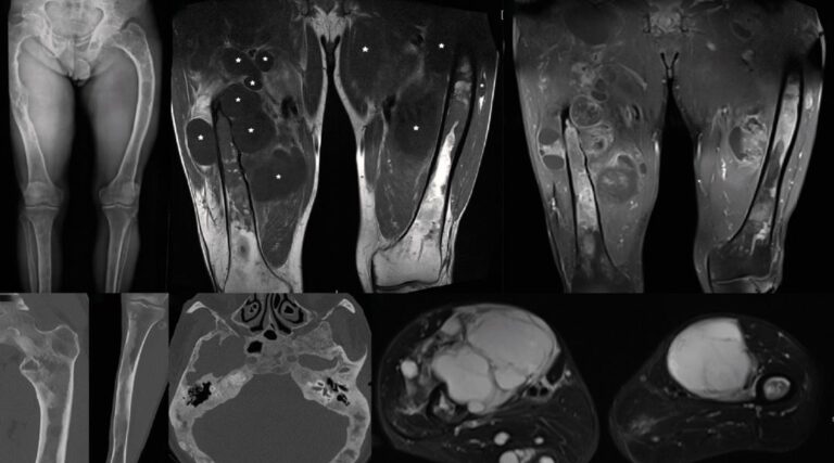 Scopri di più sull'articolo Radiomic features for patients with primary soft tissue sarcomas: A prognostic study