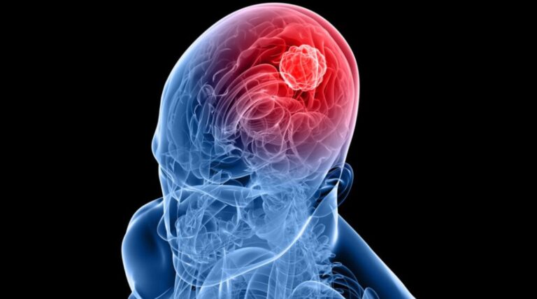 Scopri di più sull'articolo A Two-Stage Atrous Convolution Neural Network for Brain Tumor Segmentation and Survival Prediction