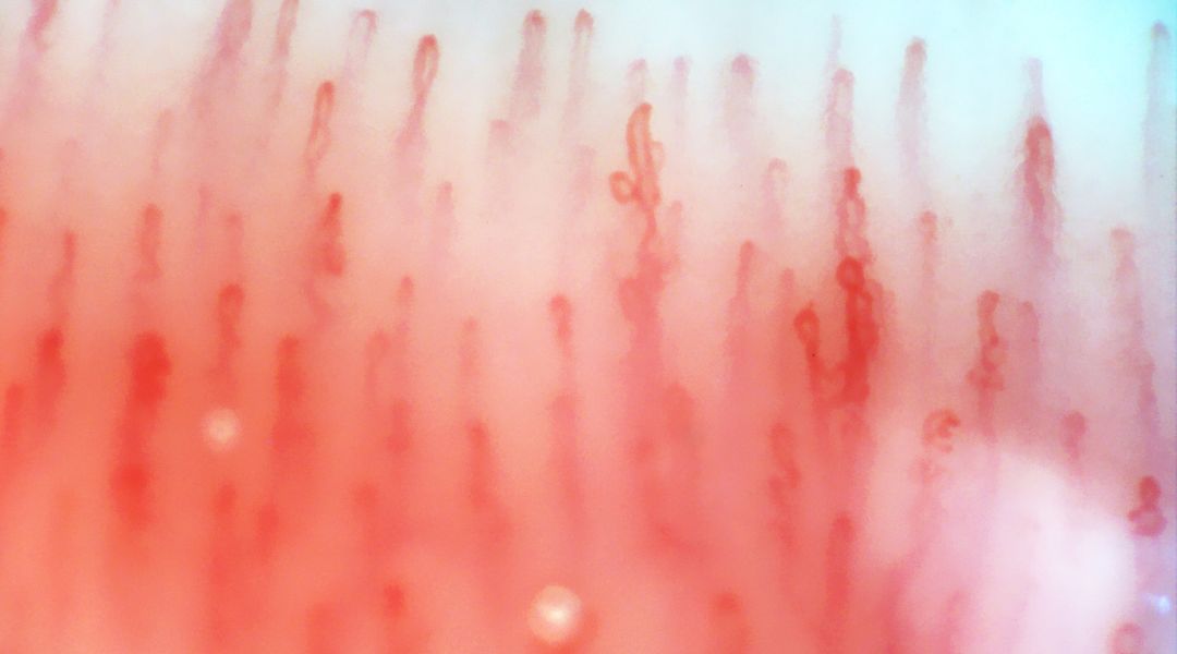capillaroscopia